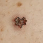 Grain de beauté suspect